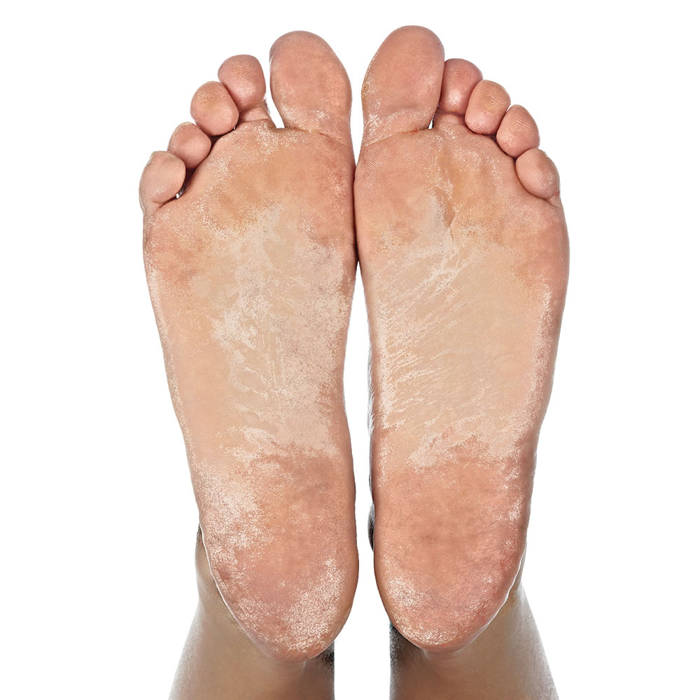 Foot Callus 9