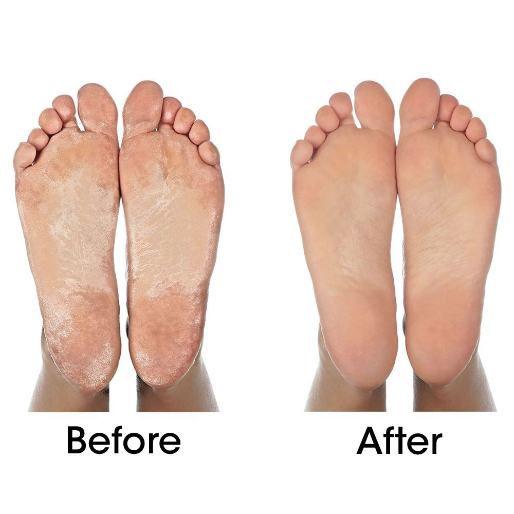 Callus On Bottom Of Foot Treatment